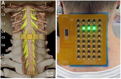 Case study: persistent recovery of hand movement and tactile sensation in peripheral nerve injury using targeted transcutaneous spinal cord stimulation